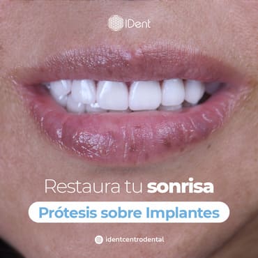 Implantes