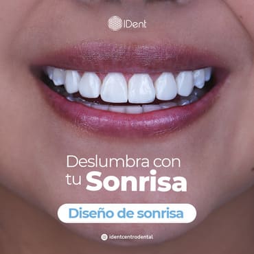 Diseño de Sonrisa